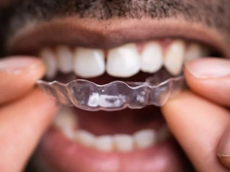 A patient placing a clear aligner during orthodontic treatment